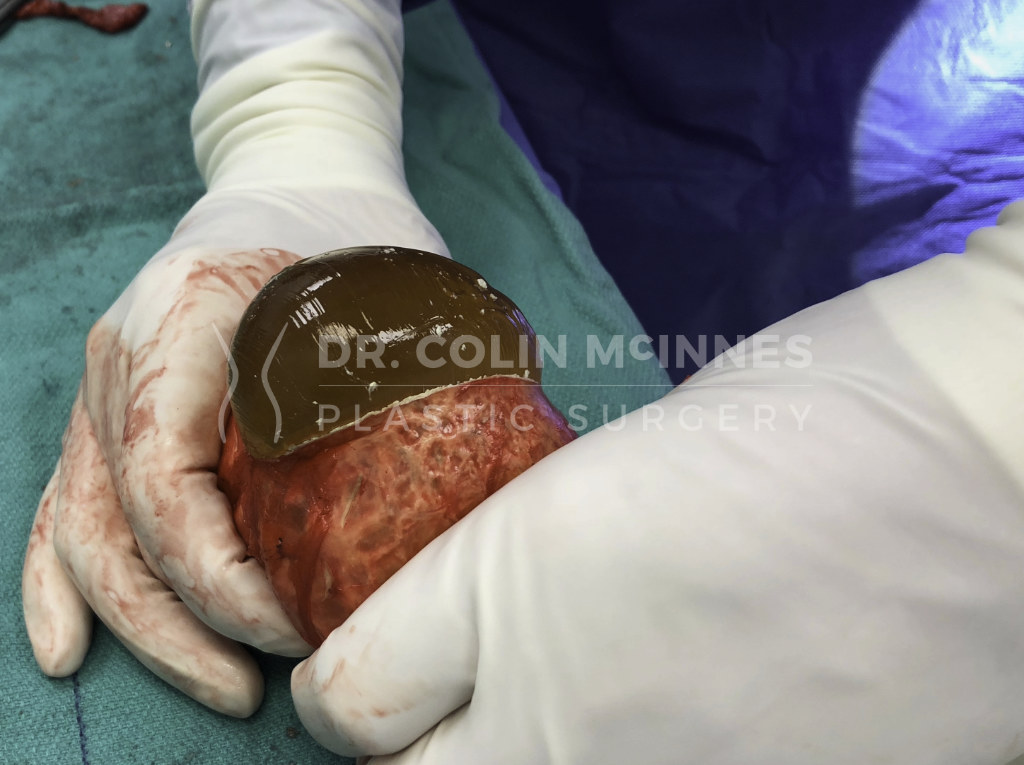 en-bloc capsulectomy (operative photos)