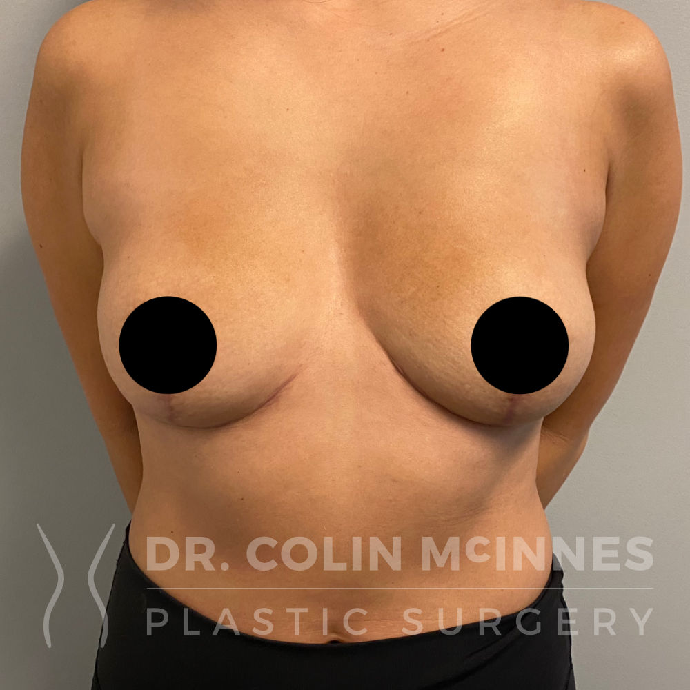 En-Bloc Explant with Immediate Breast Lift - 4 MONTHS POST OP