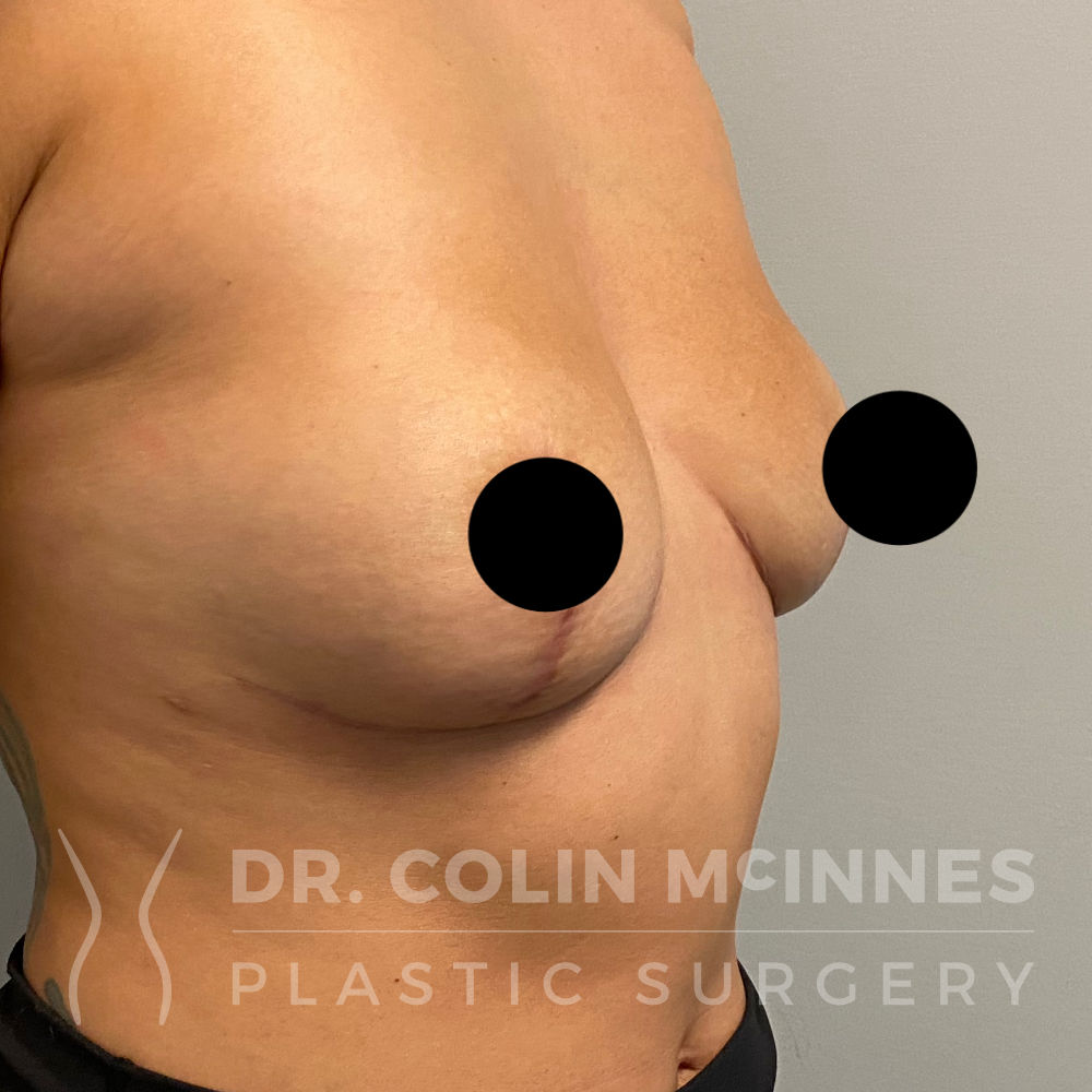 Breast Implant Removal & Capsulectomy