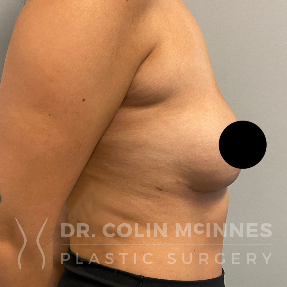 En-Bloc Explant with Immediate Breast Lift - 4 MONTHS POST OP