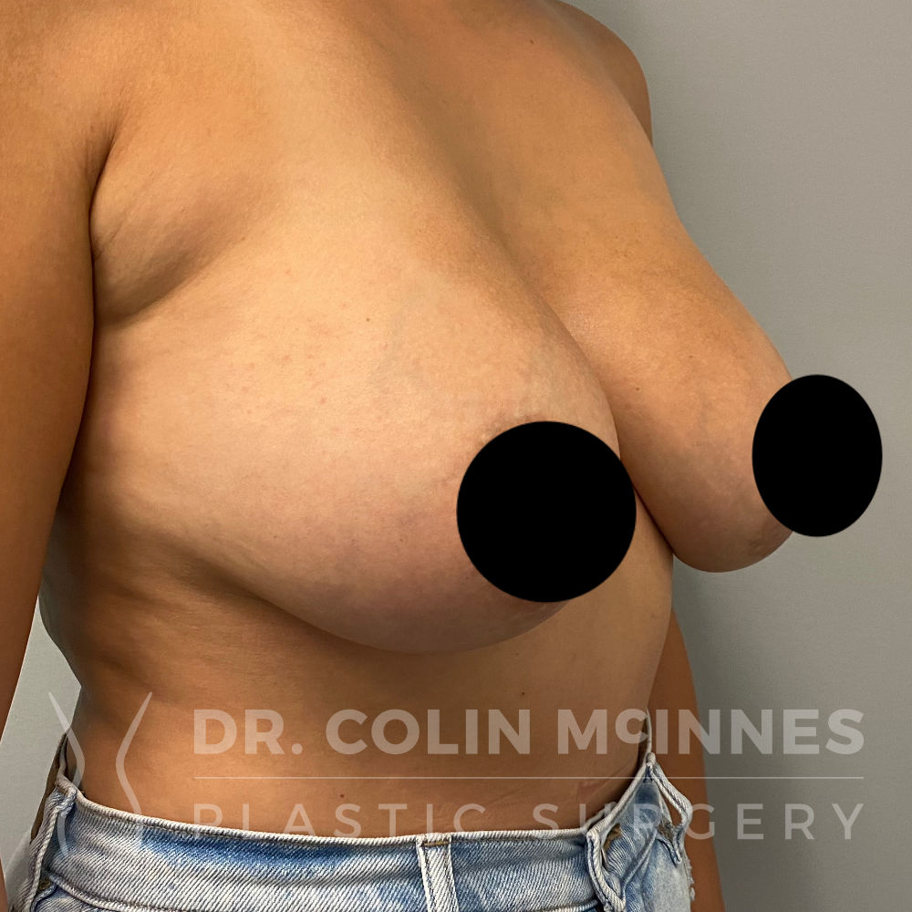 Getting rid of your implants doesn't mean you have to part ways