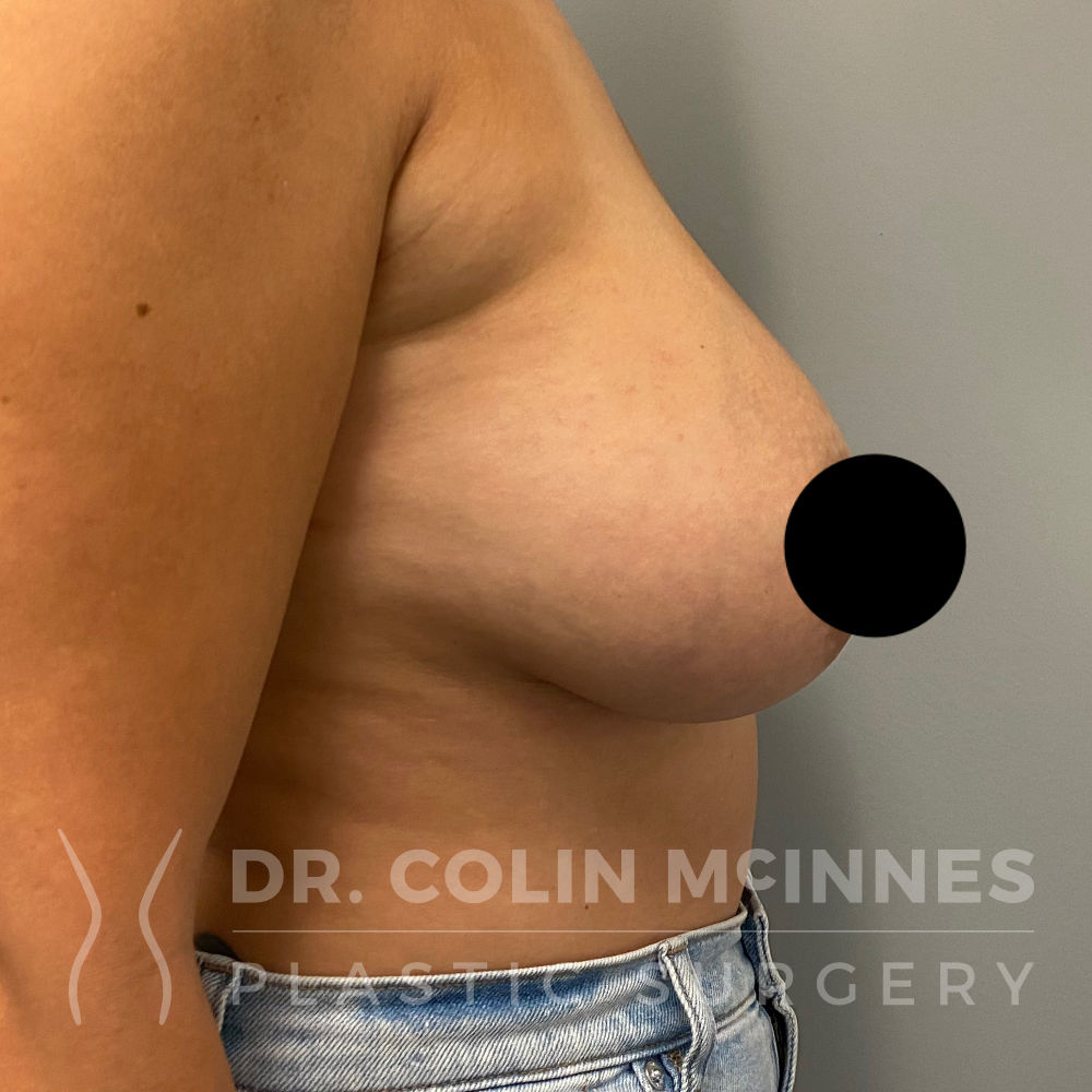 Breast implant removal (explant) Case 1 Before After Photos Orange County