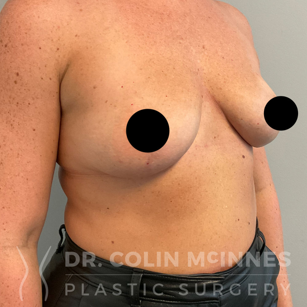 Explant + Mastopexy (Lift) - 21 MONTHS AFTER