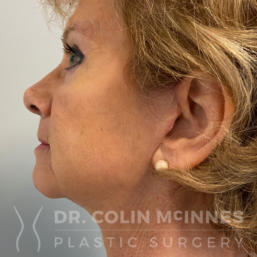 Face and Neck Lift - AFTER