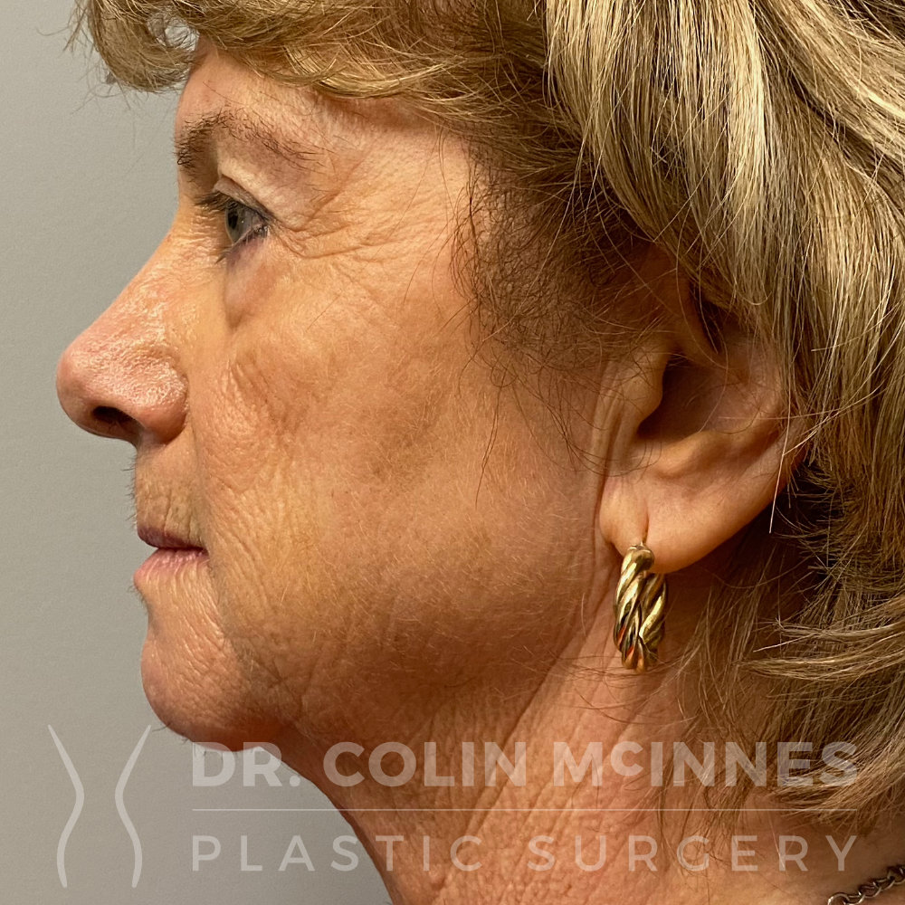 Face and Neck Lift - BEFORE