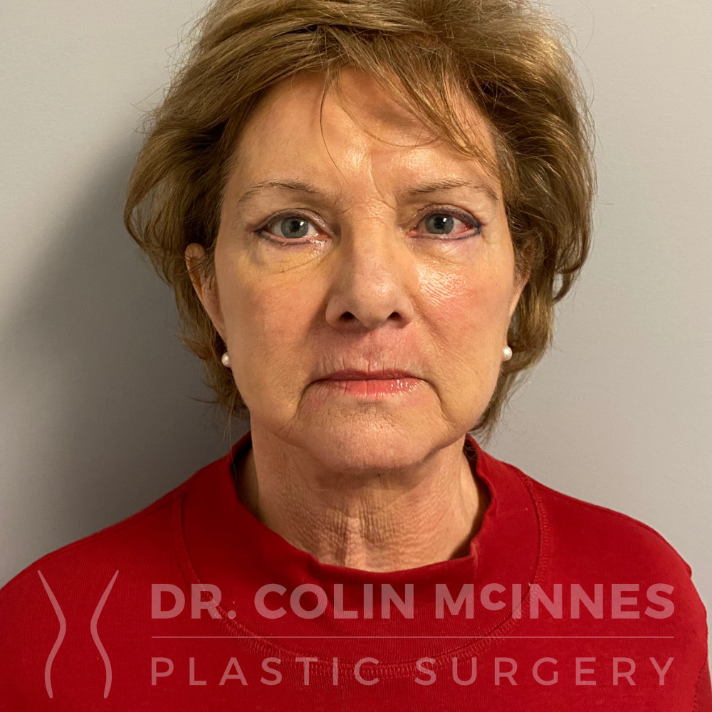 Deep Plane Face and Neck Lift, Brow Lift, Lower Eyelid Blepharoplasty, Fat Grafting, Dermabrasion - AFTER
