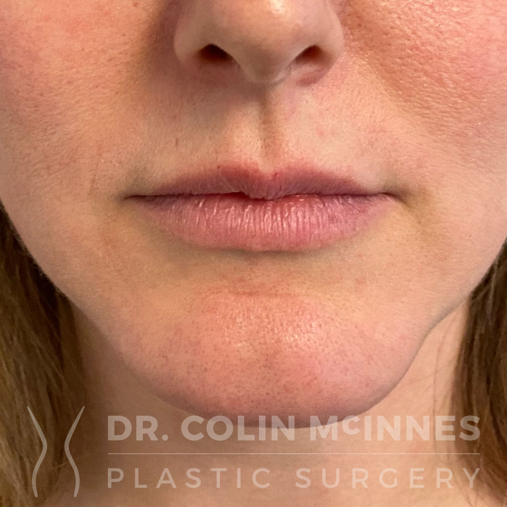 Lip Filler - BEFORE Lip Filler - BEFORE