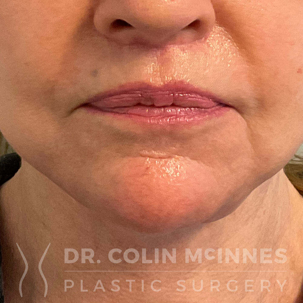 Lip Lift w/ Deep Plane Release - AFTER