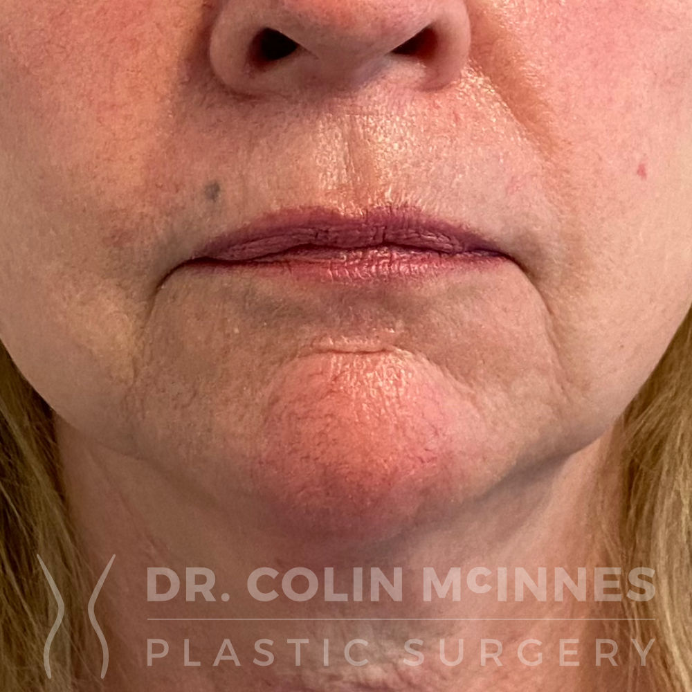 Lip Lift w/ Deep Plane Release - BEFORE