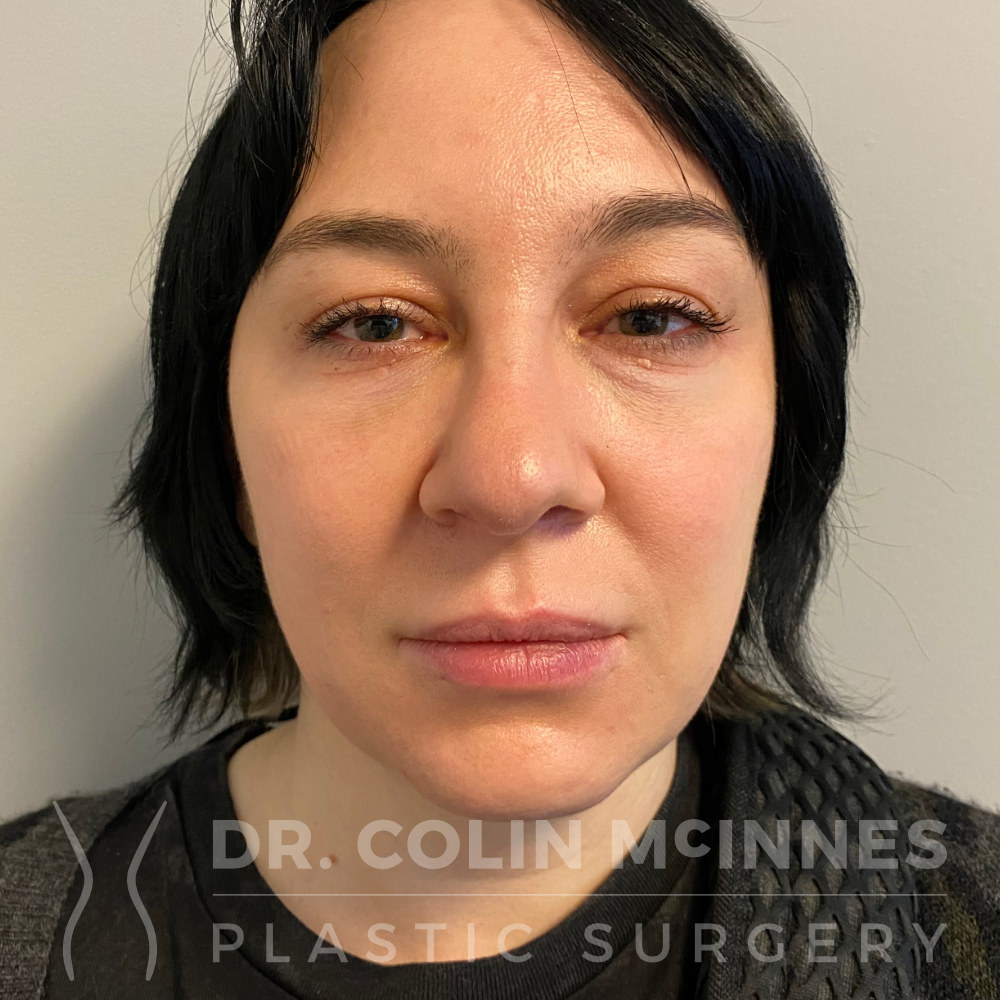 Lip Lift + Right Brow Lift (brown asymmetry correction) - BEFORE