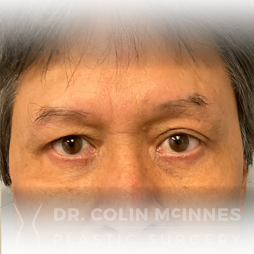 Lower Eyelid Blepharoplasty - AFTER (11 MONTHS)