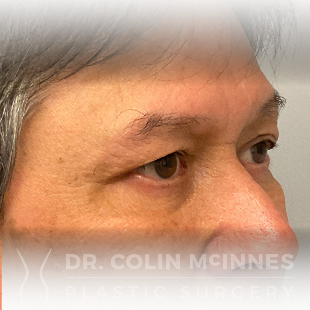 Lower Eyelid Blepharoplasty - AFTER (11 MONTHS)