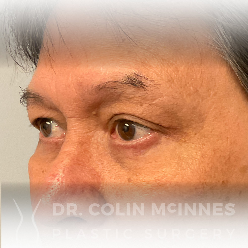 Lower Eyelid Blepharoplasty - AFTER (11 MONTHS)