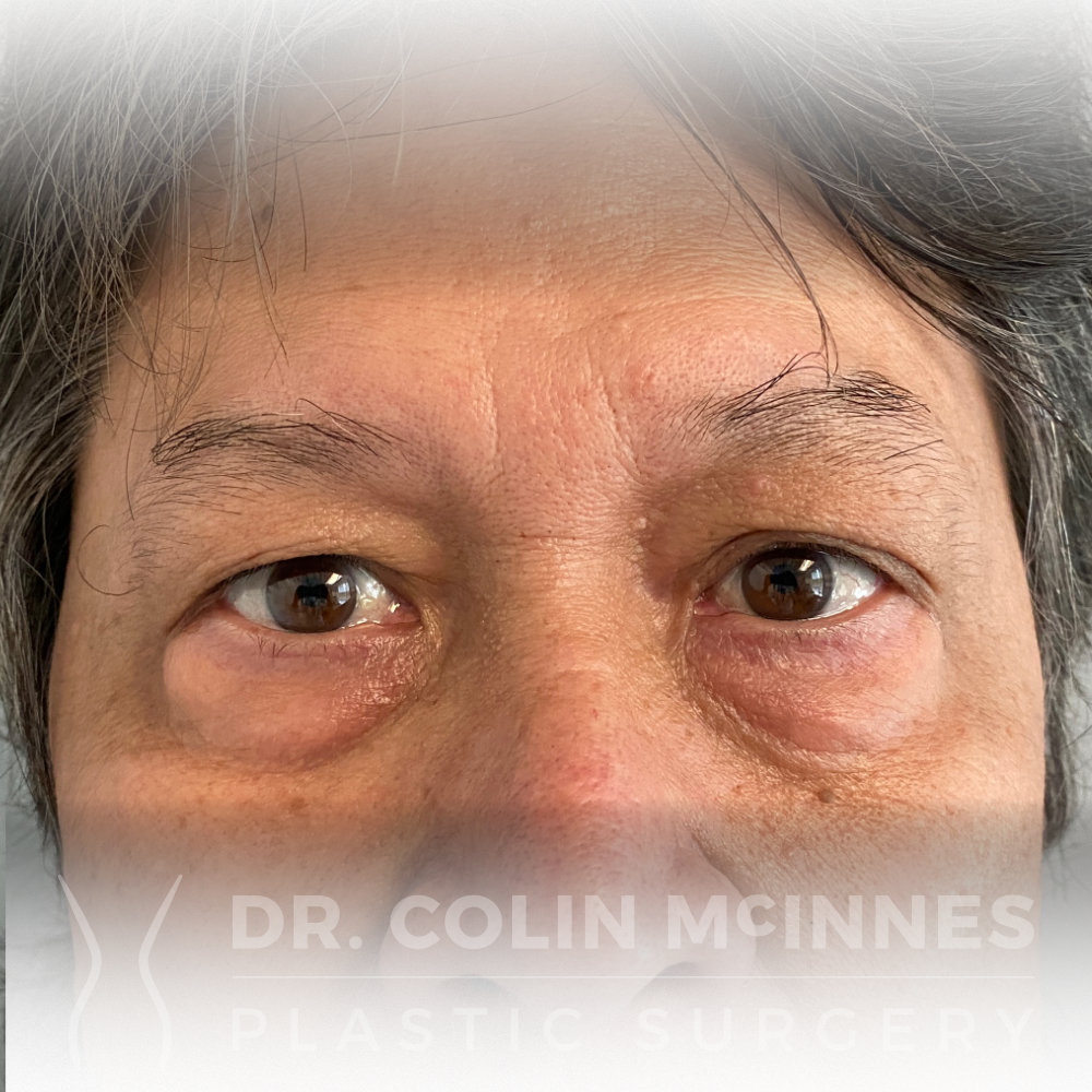 Lower Eyelid Blepharoplasty - BEFORE