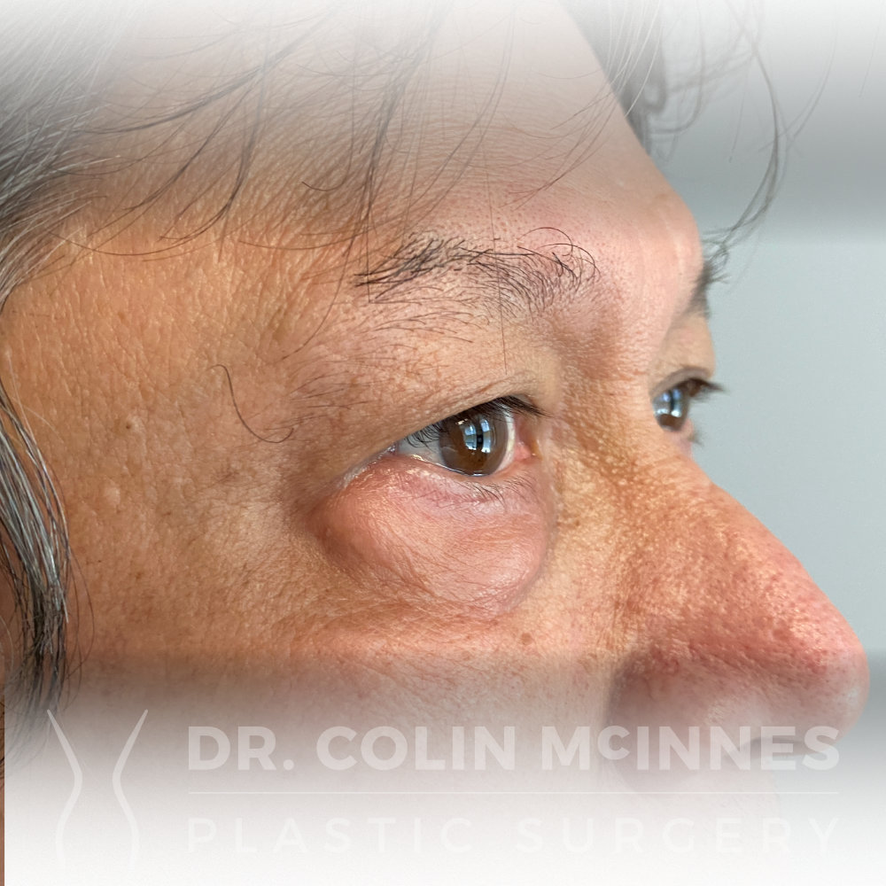 Lower Eyelid Blepharoplasty - BEFORE