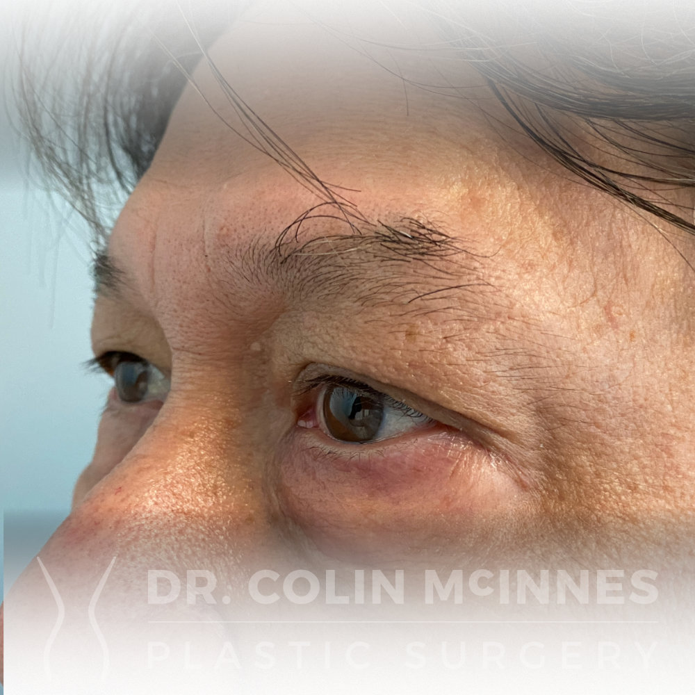 Lower Eyelid Blepharoplasty - BEFORE