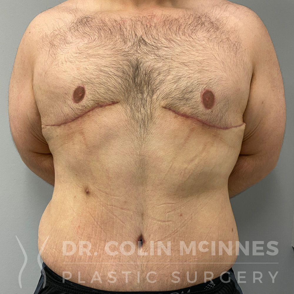 Male Weight Loss Contouring: Pedicled Chest Lift and Abdominoplasty + Lipo - 8 WEEKS AFTER