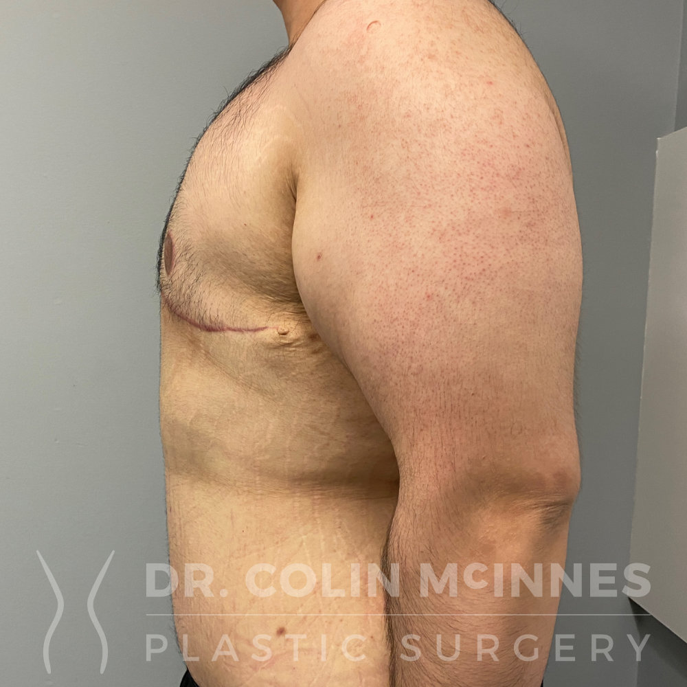 Male Weight Loss Contouring: Pedicled Chest Lift and Abdominoplasty + Lipo - 8 WEEKS AFTER