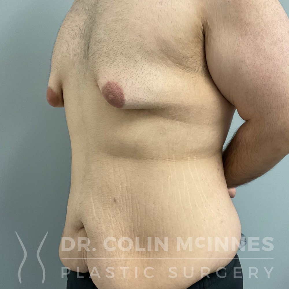 Male Weight Loss Contouring: Pedicled Chest Lift and Abdominoplasty + Lipo - BEFORE