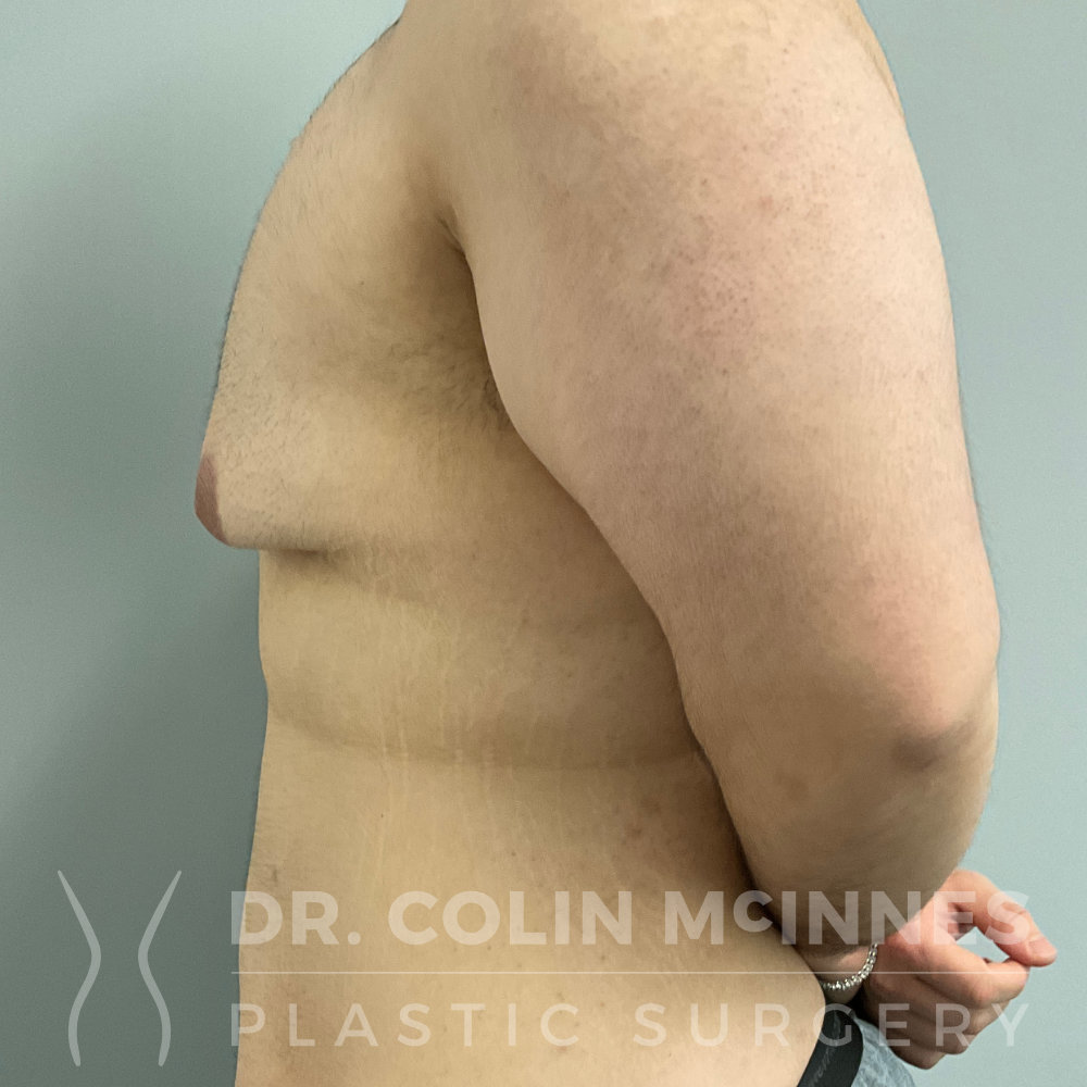 Male Weight Loss Contouring: Pedicled Chest Lift and Abdominoplasty + Lipo - BEFORE