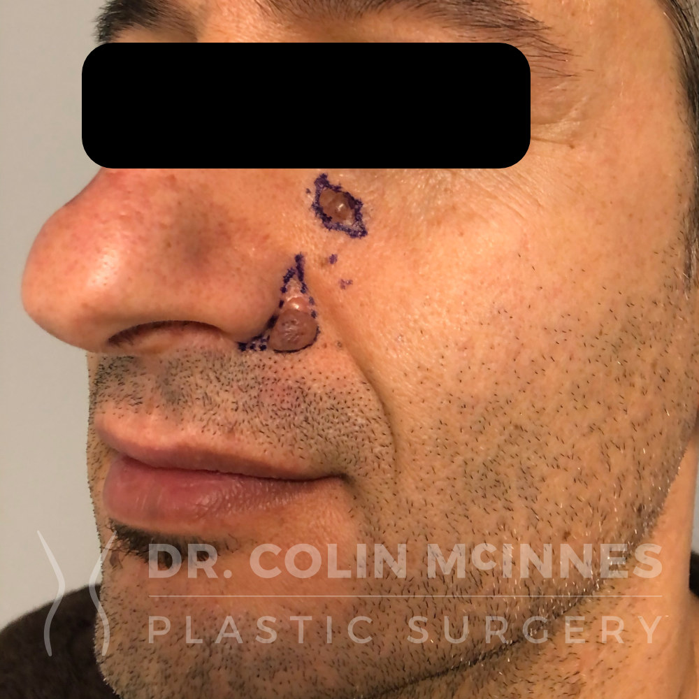 Cosmetic Mole Removal - BEFORE