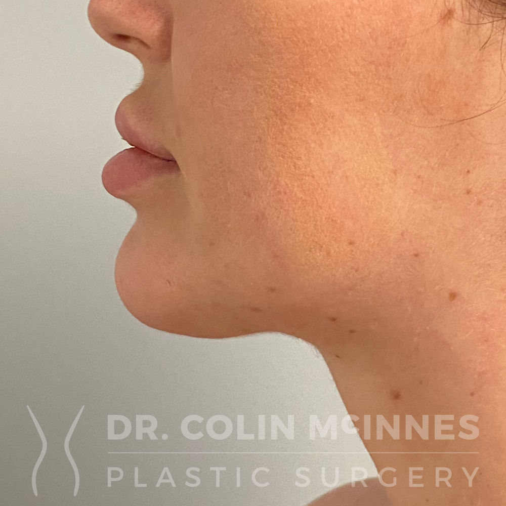 Submental Neck Liposuction - 9 MONTHS POST-OP