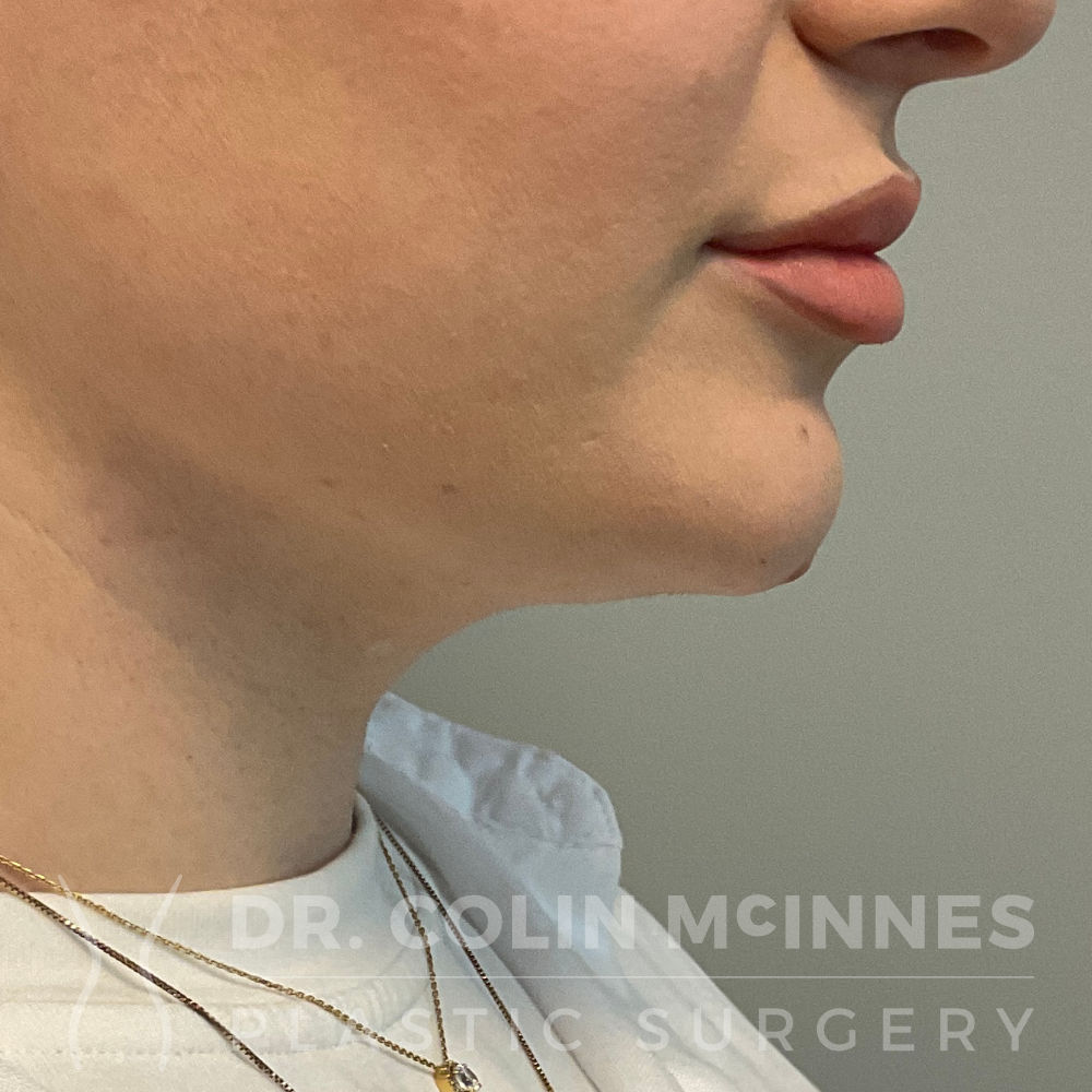 Neck & Jawline Liposuction - 4 MONTHS AFTER