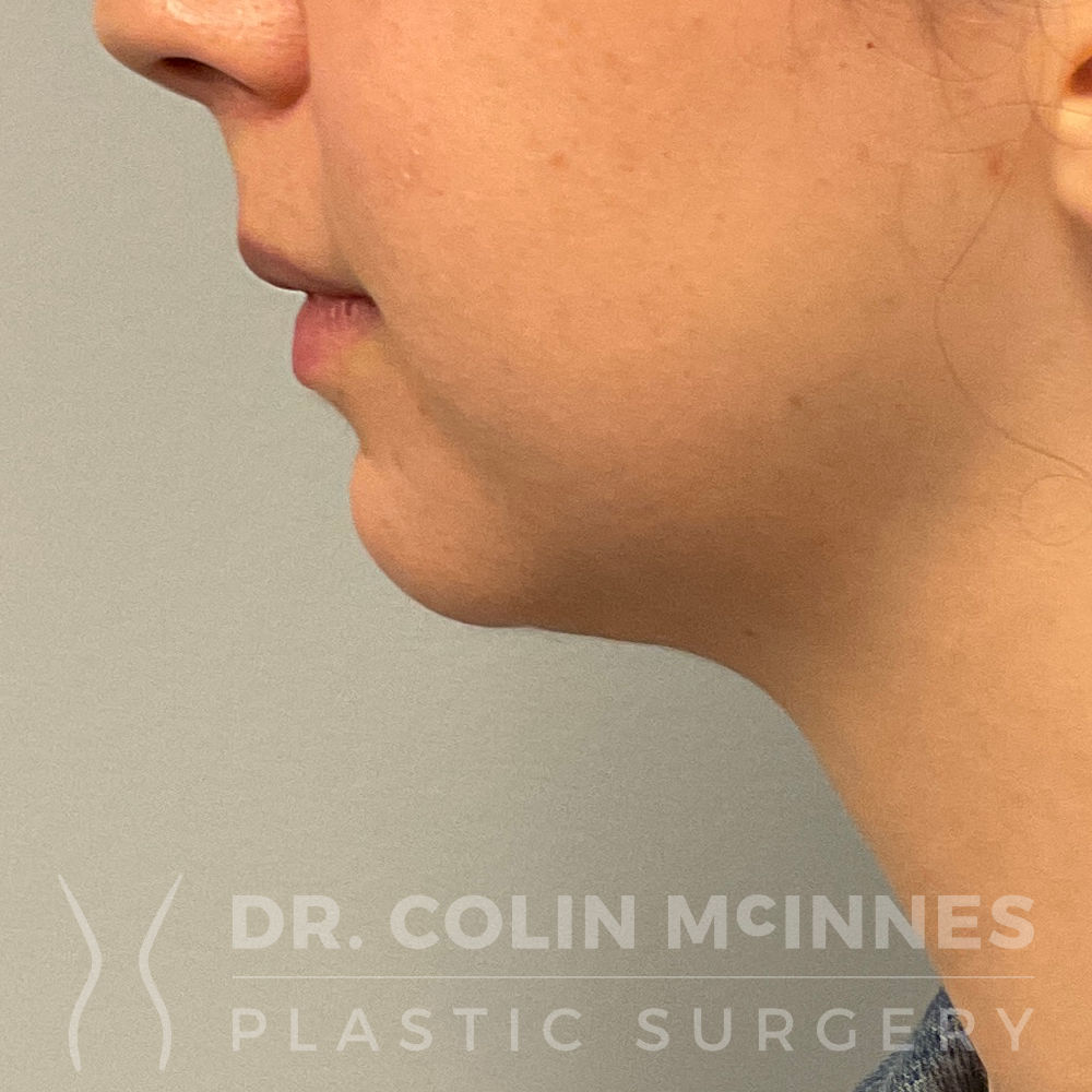 Neck & Jawline Liposuction - 6 MONTHS AFTER