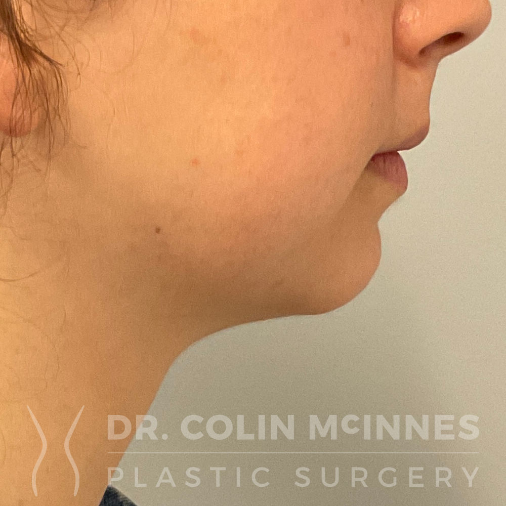 Neck & Jawline Liposuction - 6 MONTHS AFTER