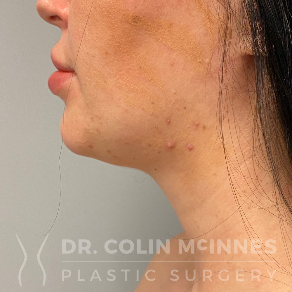 Submental Neck Liposuction - BEFORE
