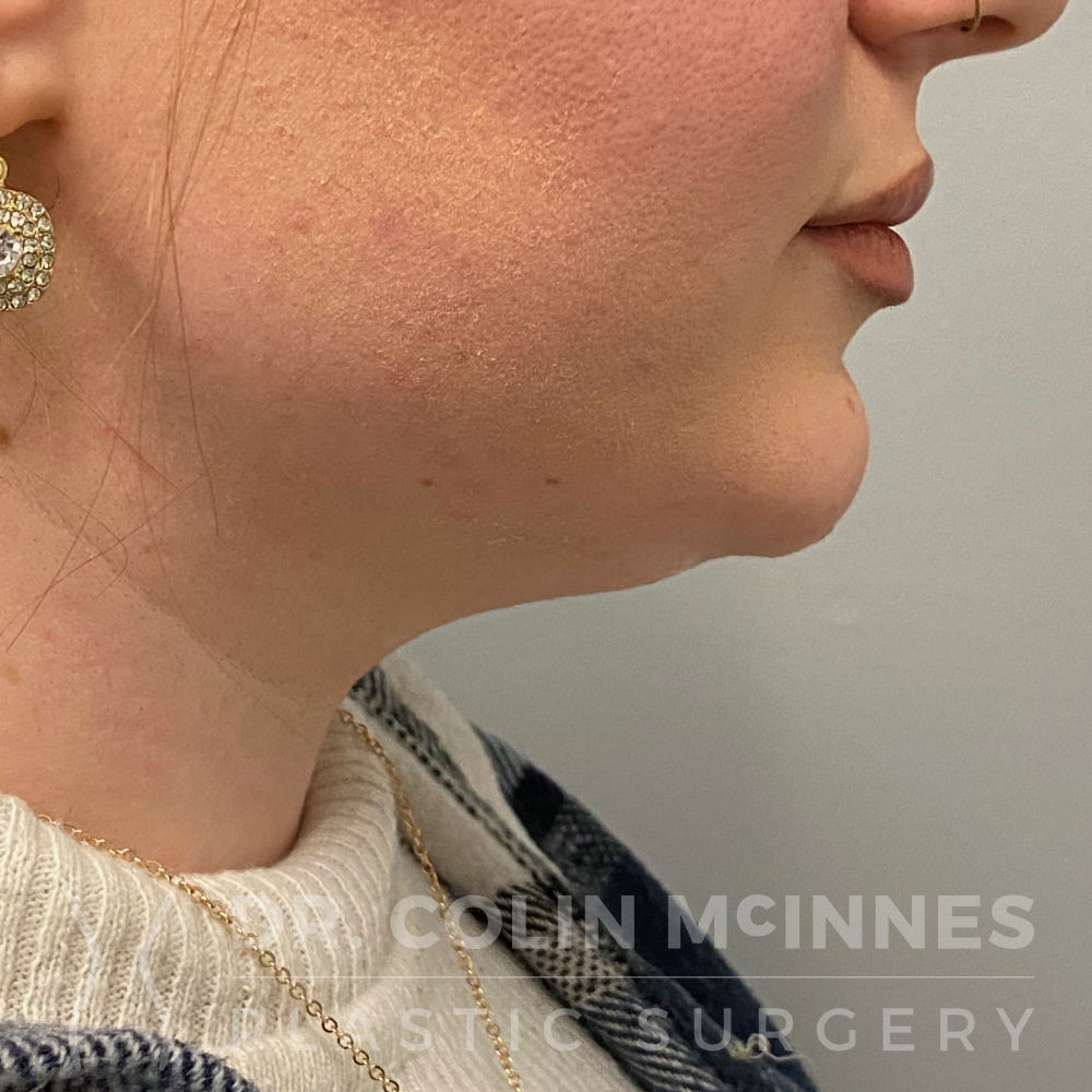 Neck & Jawline Liposuction - BEFORE