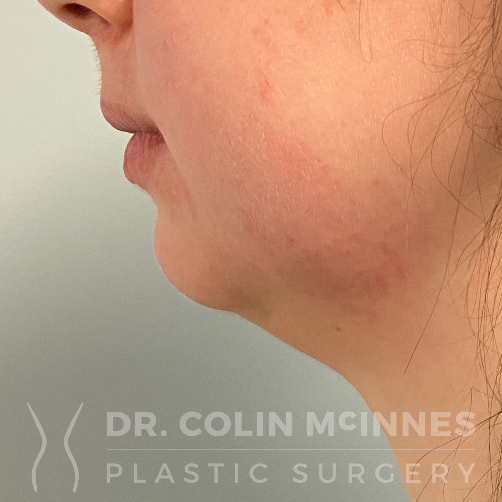 Neck & Jawline Liposuction - BEFORE