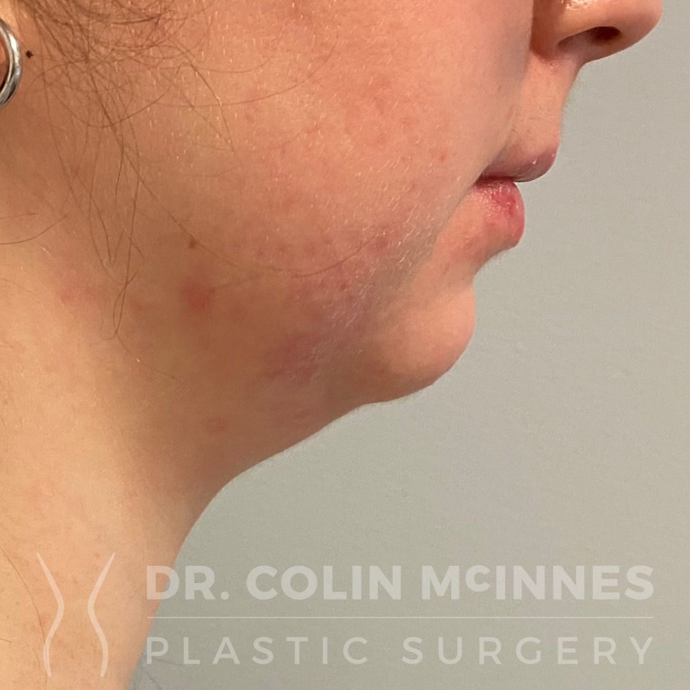 Neck & Jawline Liposuction - BEFORE