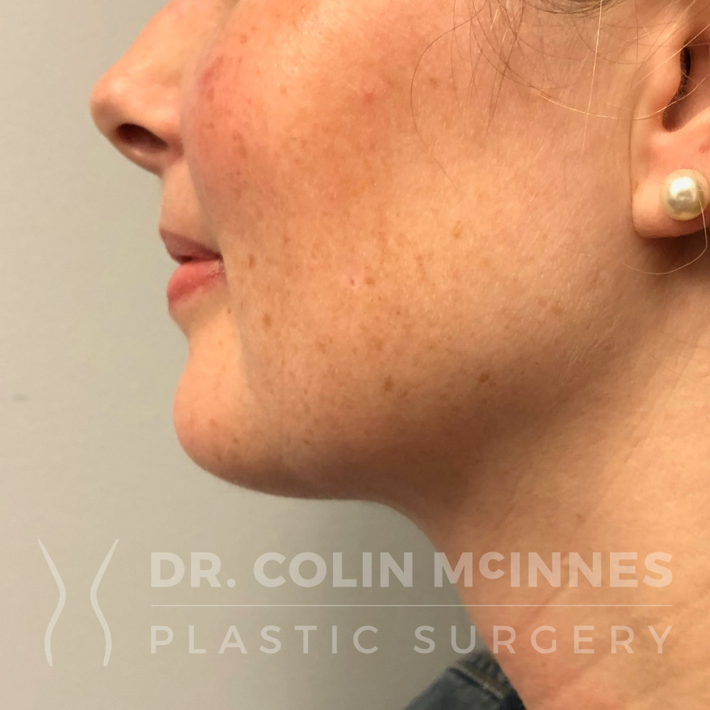 Neck Liposuction - AFTER