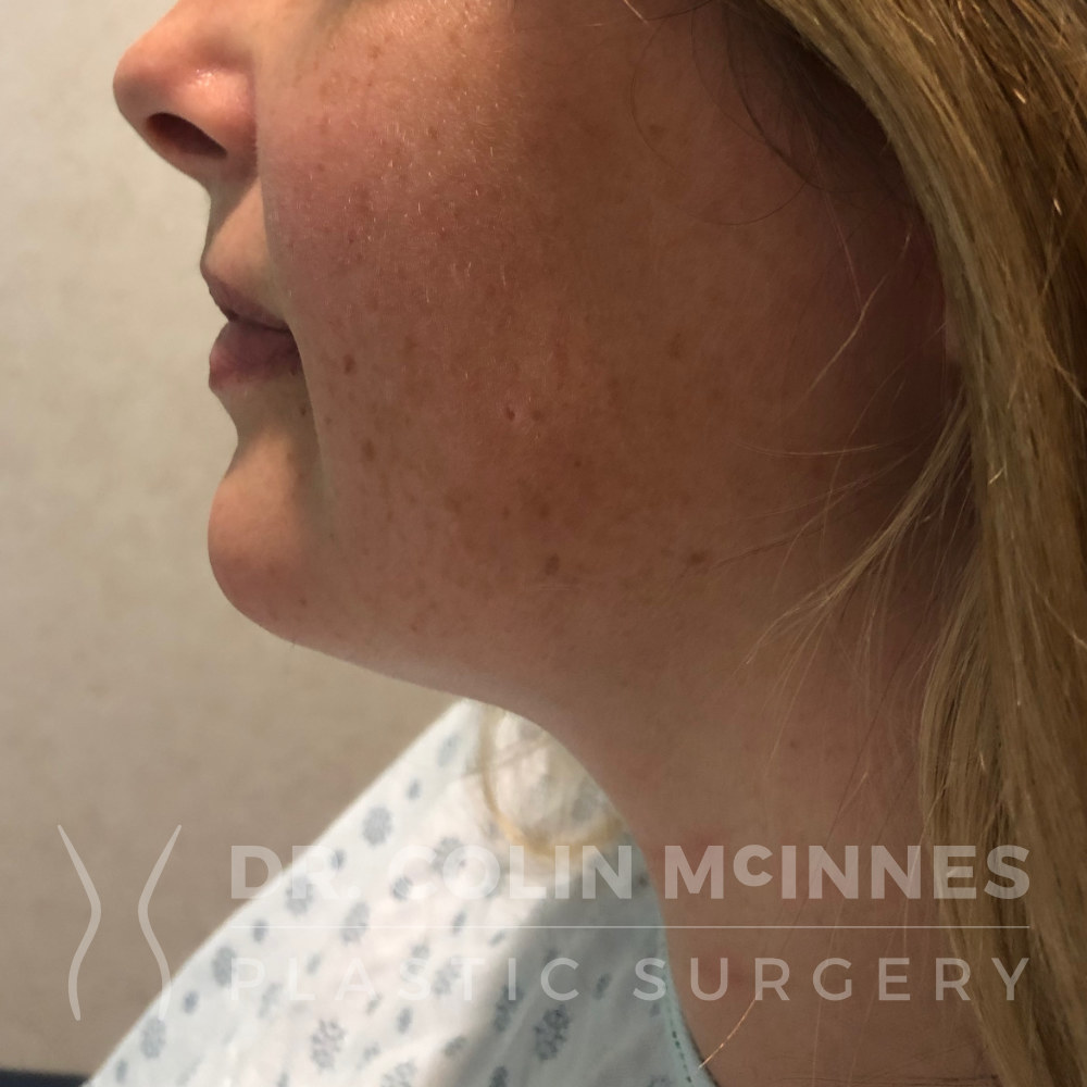 Neck Liposuction - BEFORE