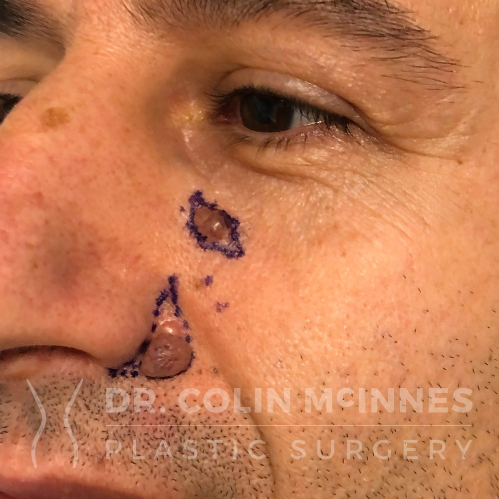 Precision Nevus Excision - BEFORE