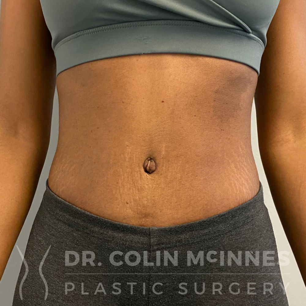 Tummy Tuck - AFTER