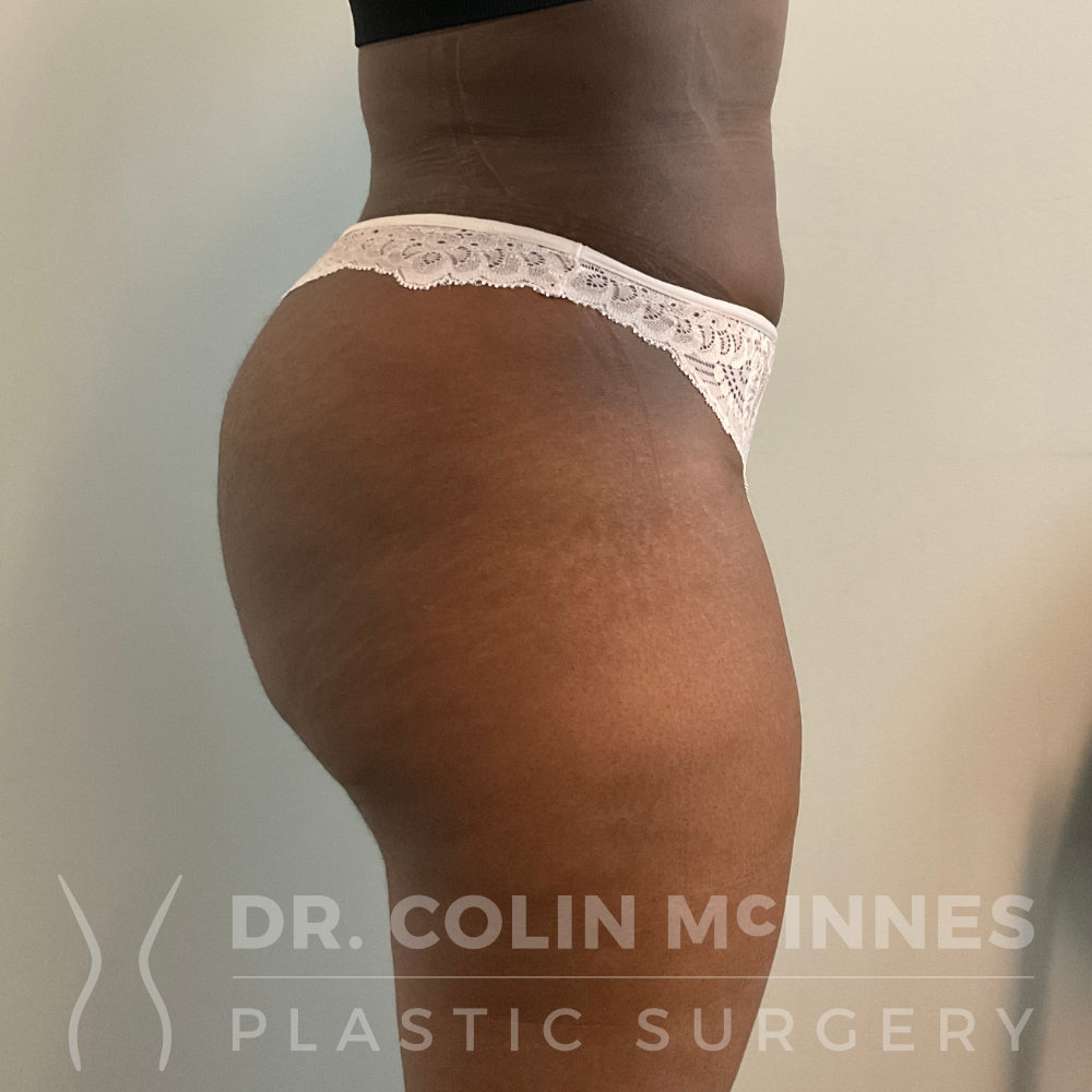 Brazilian Butt Lift (BBL) Surgery