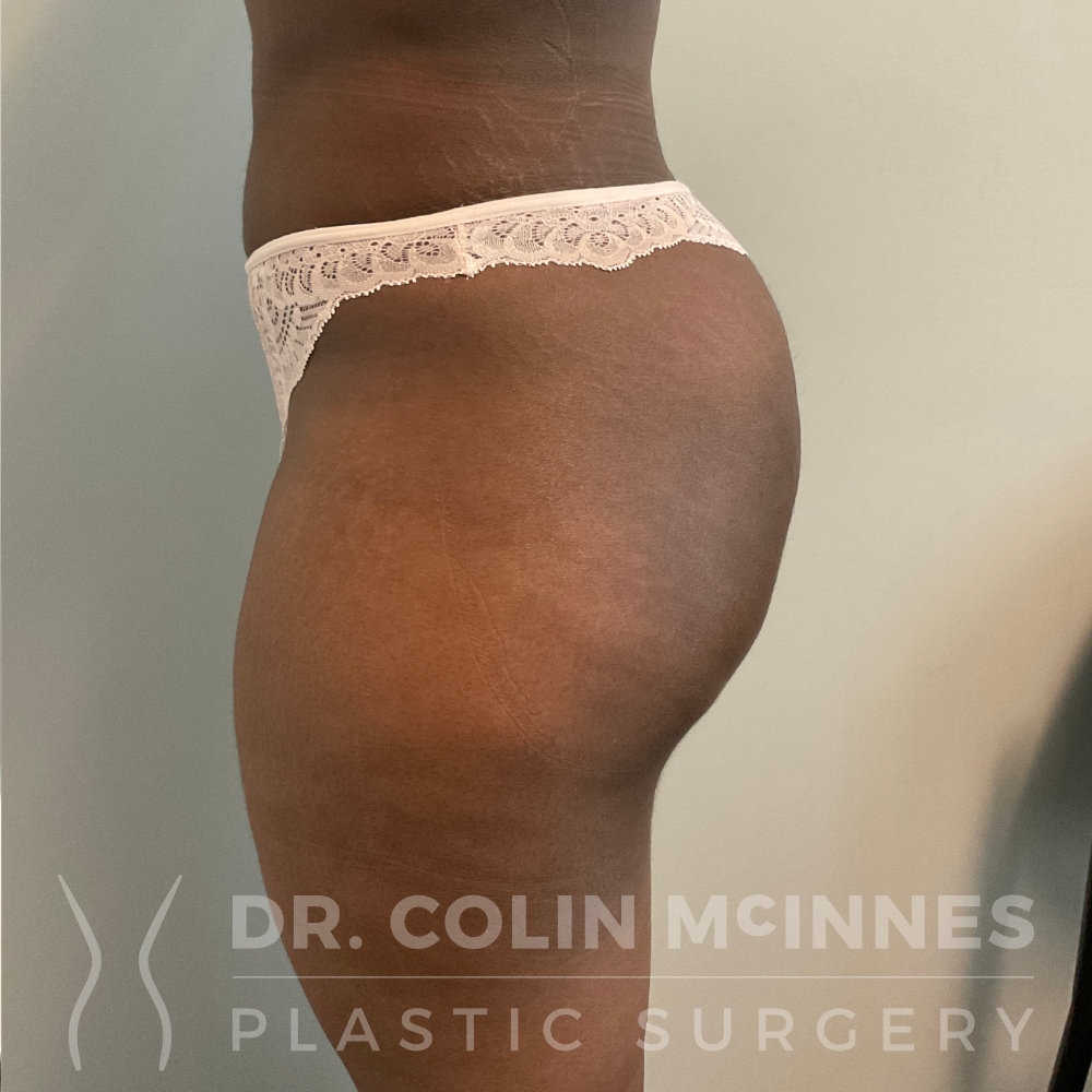 Ultrasound-Guided BBL + Lipo360 - 2 MONTHS AFTER