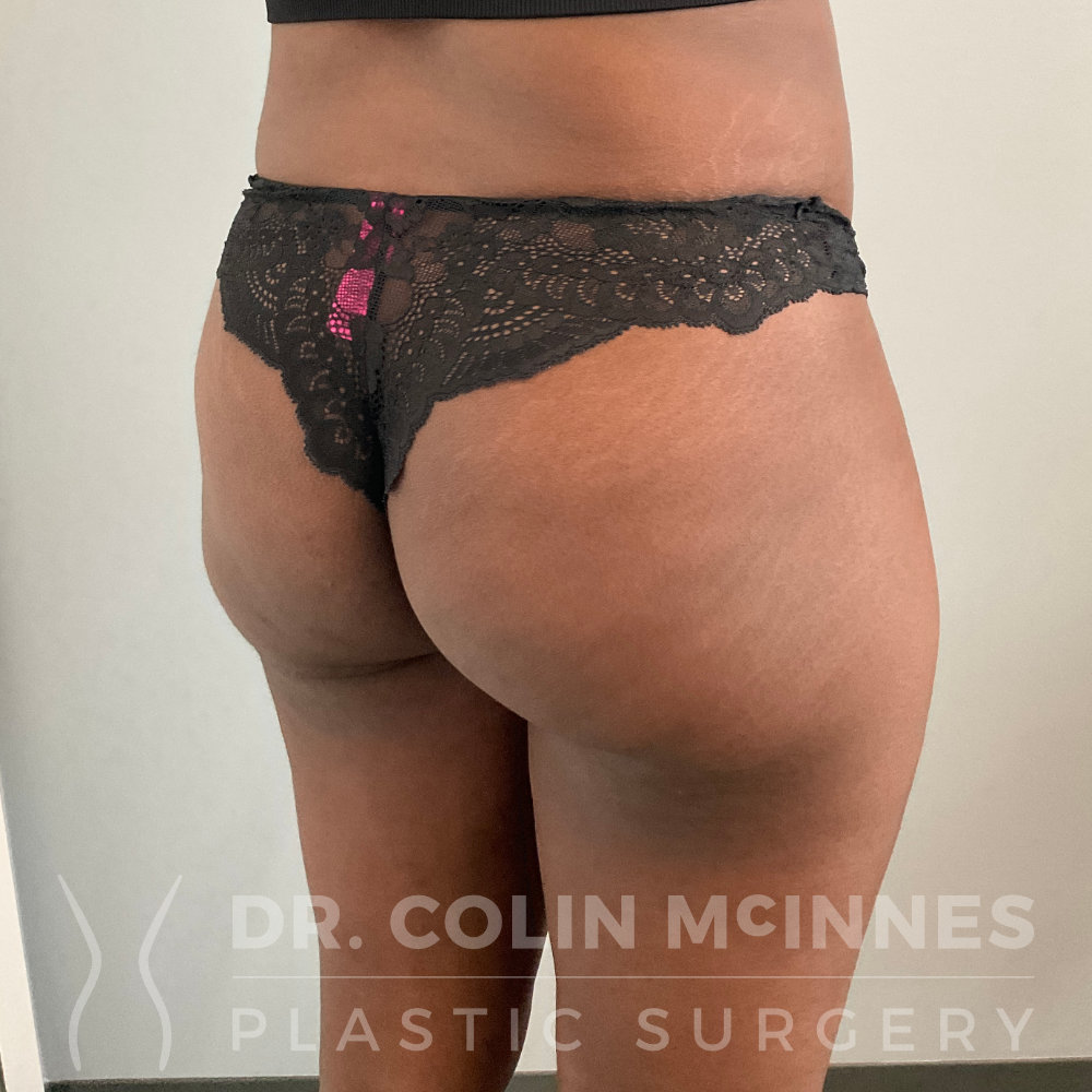 Brazilian Butt Lift (BBL) Surgery