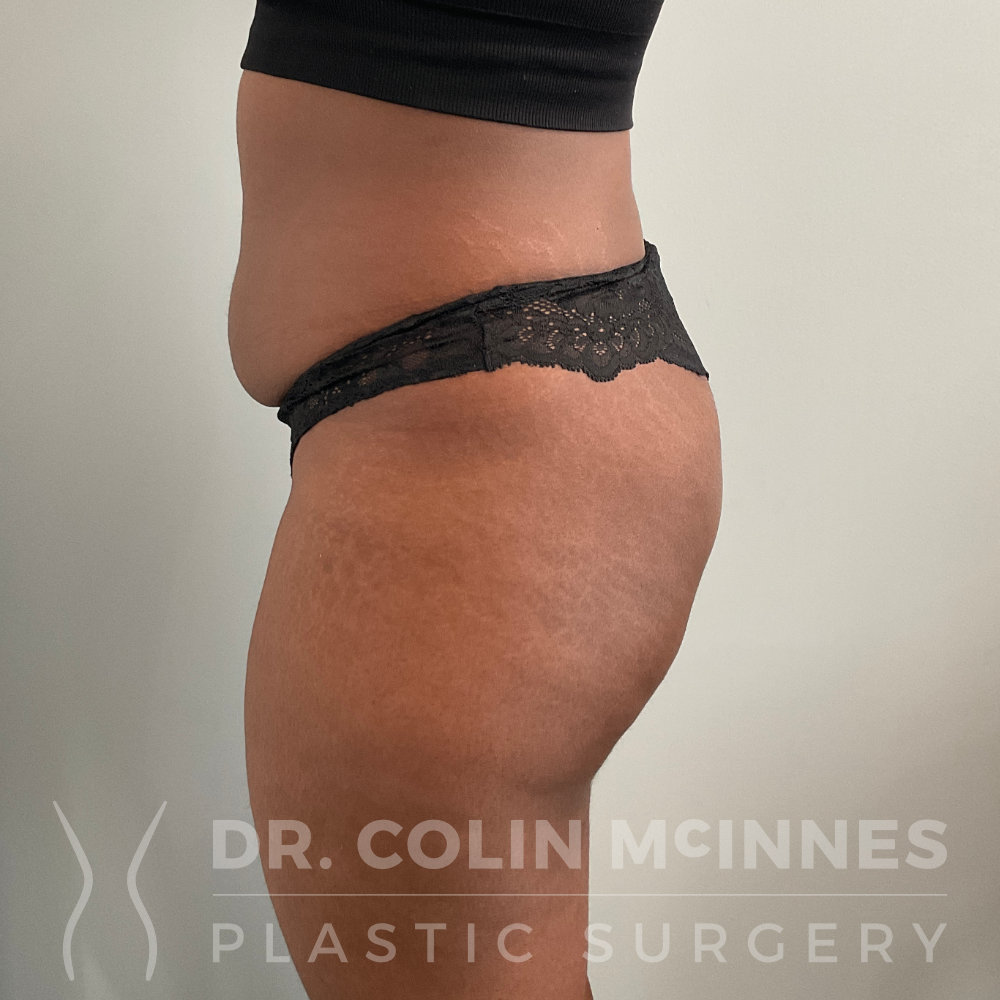 Estaline Clinic En - What is BBL? Brazilian butt lift is plastic surgery  that is based on the fat transfer process to improve the size and shape of  the buttock. With liposuction