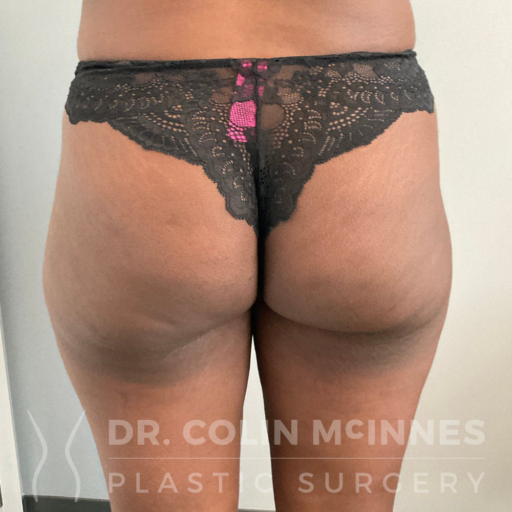 Brazilian Butt Lift (BBL) Surgery