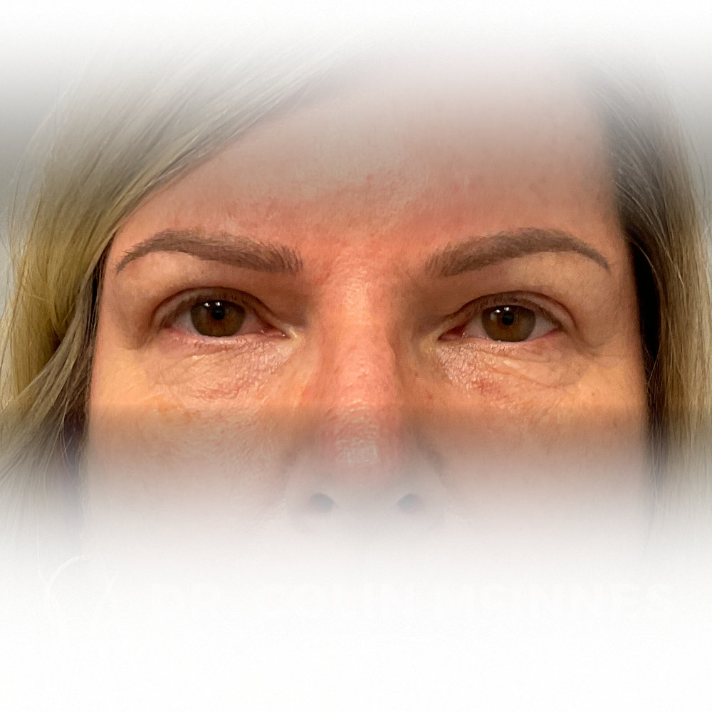 Right Side Brow Lift & Bilateral Upper Blepharoplasty - AFTER (1 YEAR)