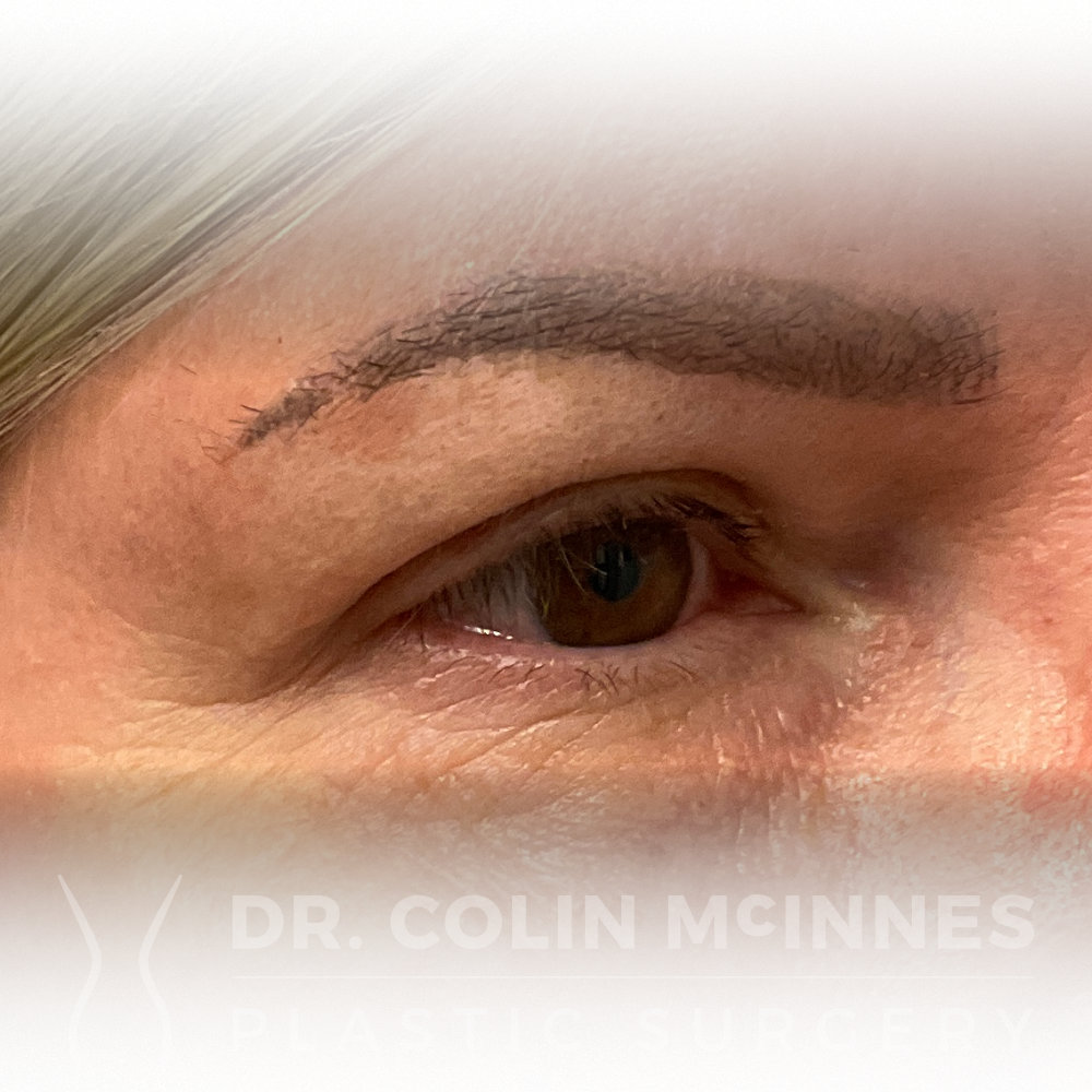 Right Side Brow Lift & Bilateral Upper Blepharoplasty - AFTER (1 YEAR)