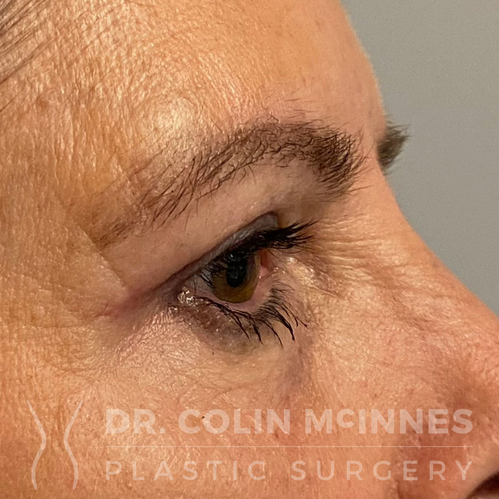 Upper Eyelid Blepharoplasty - AFTER (5 WEEKS)