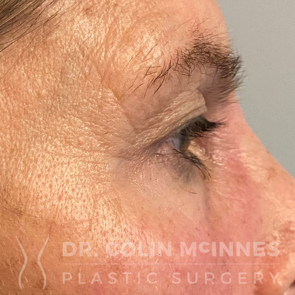 Upper Eyelid Blepharoplasty - BEFORE