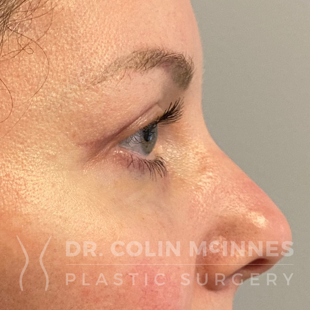 Upper Eyelid Blepharoplasty - AFTER (7 WEEKS)