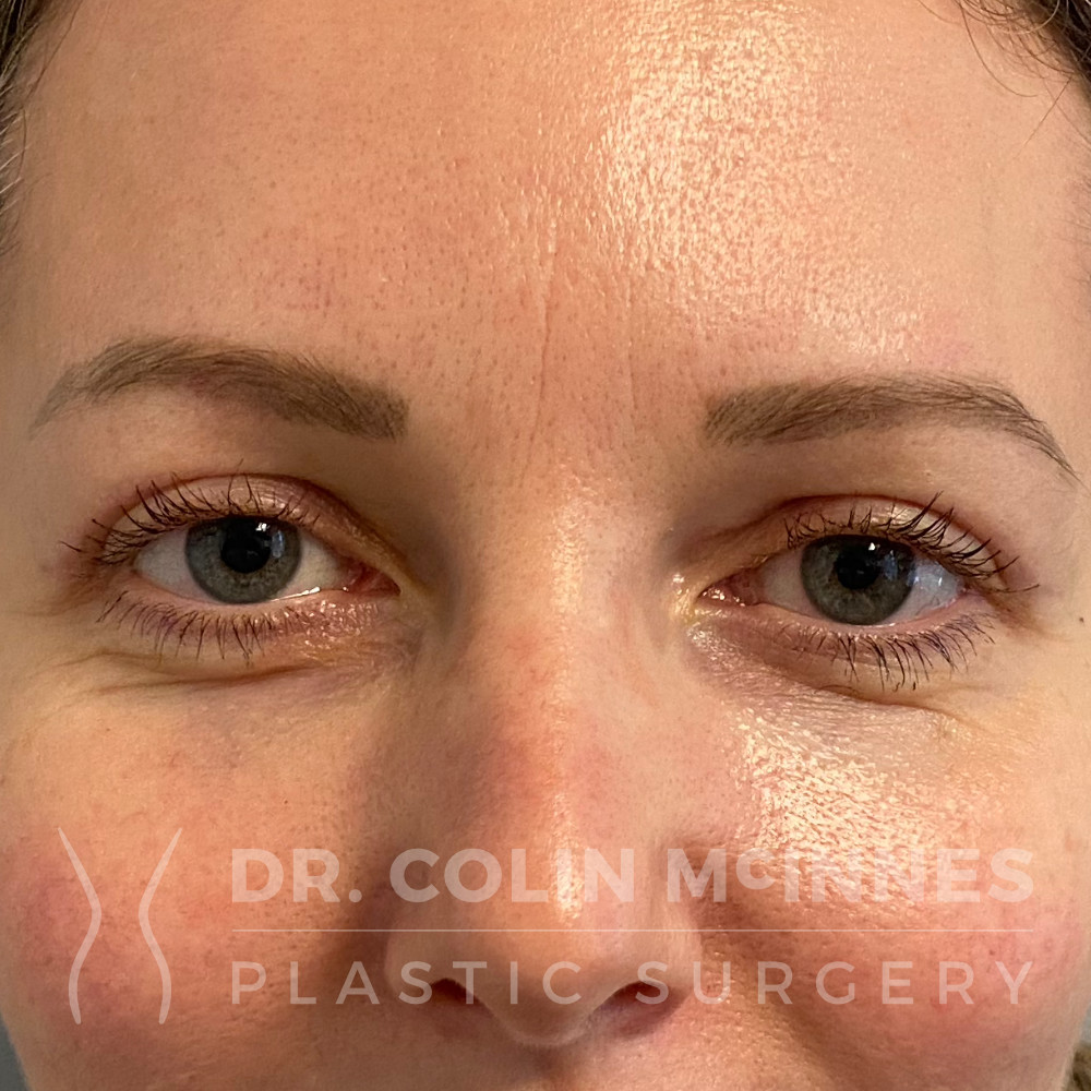 Upper Eyelid Blepharoplasty - AFTER (7 WEEKS)