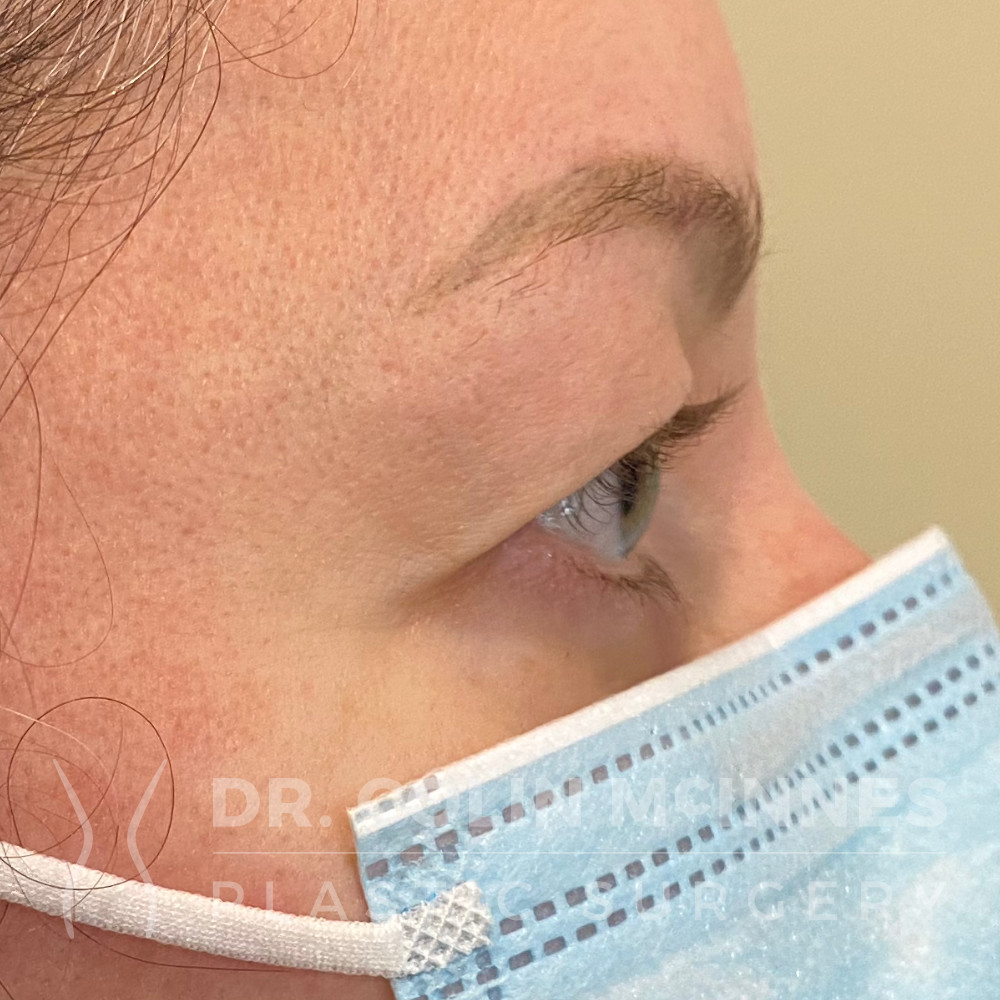 Upper Eyelid Blepharoplasty - BEFORE