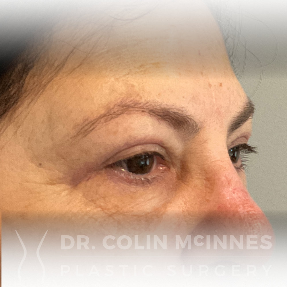 Upper Eyelid Blepharoplasty - AFTER (3 MONTHS)